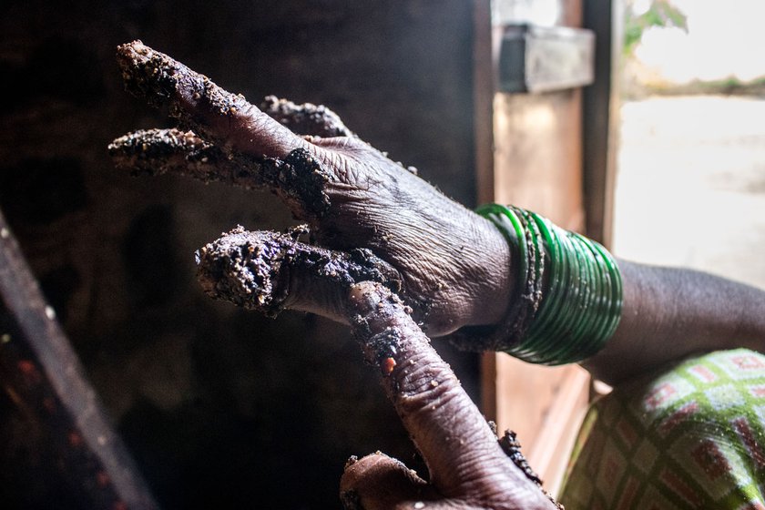 Kusum points towards her thumb and shows the castor oil’s drop forming.